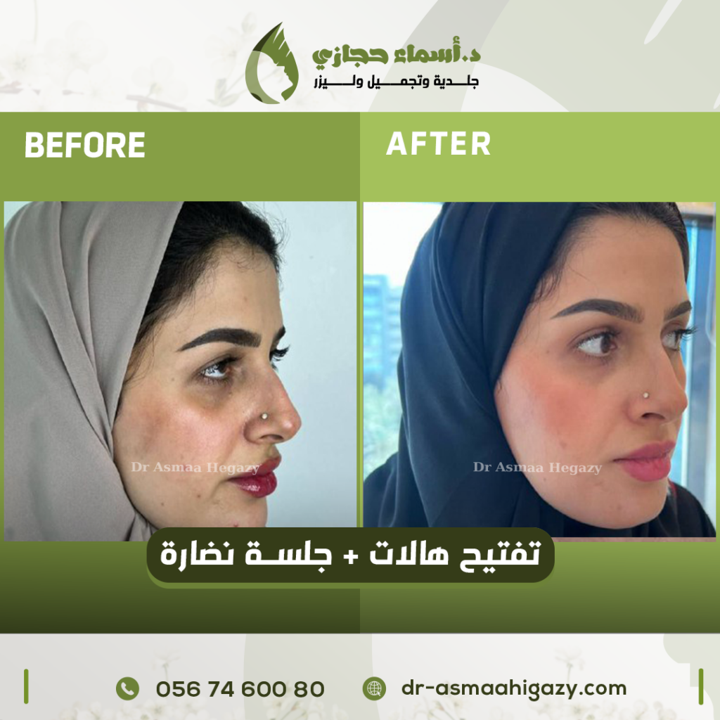 عروض علاج الهالات السوداء