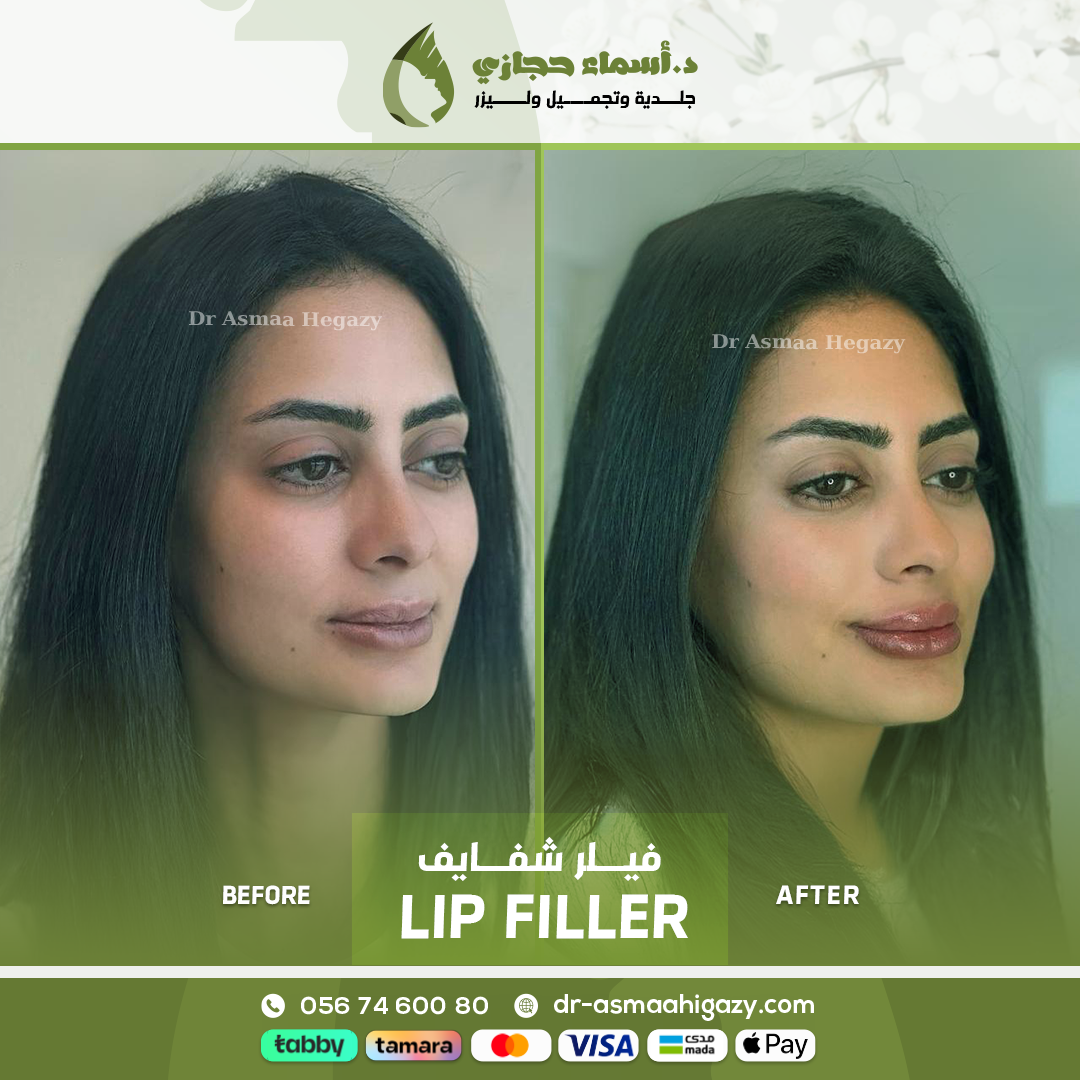 فيلر الشفايف الروسية