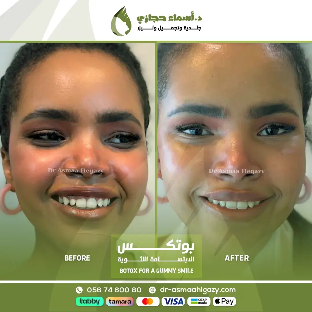بوتكس الابتسامة اللثوية