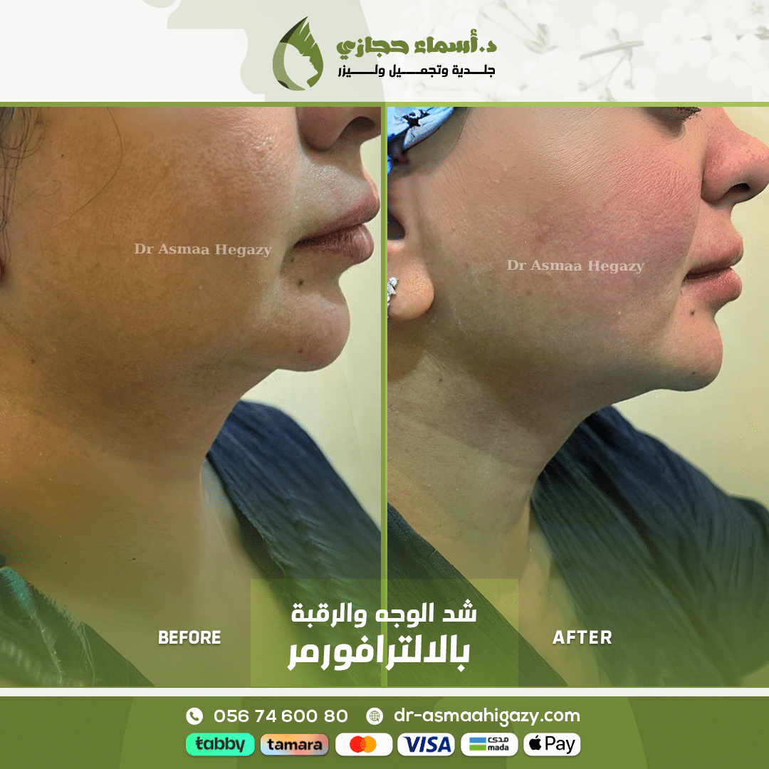 عروض الترافورمر